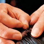 scalp acupuncture (1)