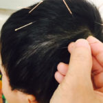 scalp acupuncture (2)