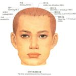 scalp acupuncture (4)