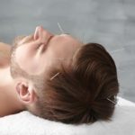 scalp acupuncture (5)
